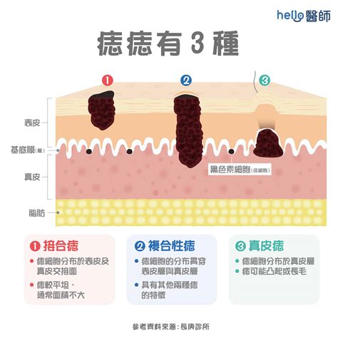 生黑痣|為什麼臉上的痣越來越多？皮膚科醫師解析長痣原因、。